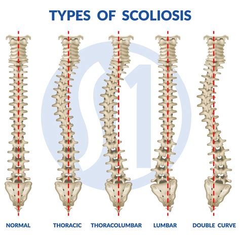 jesus dominic dael|Scoliosis is an abnormal curve of the spine into a 'c' or 's' shape .
